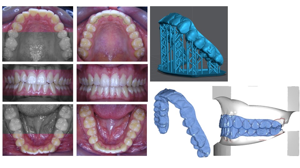 Direct (print) GRAPHY aligners Certification (inoffice) course